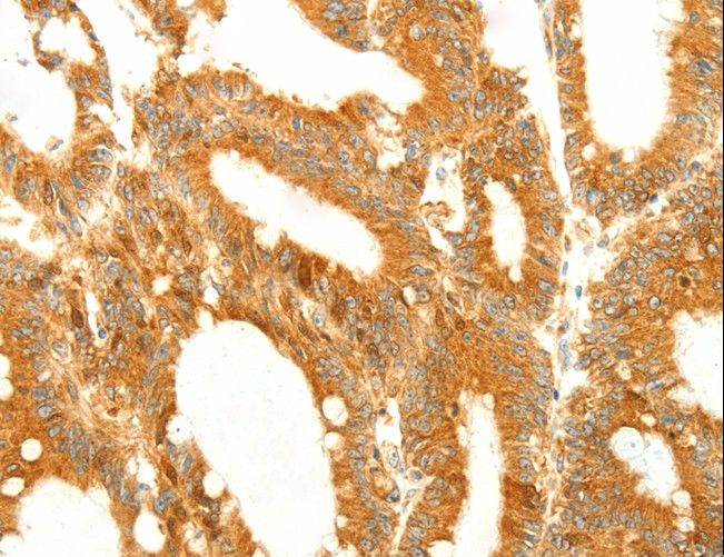 DIABLO / SMAC Antibody - Immunohistochemistry of paraffin-embedded Human colon cancer using DIABLO Polyclonal Antibody at dilution of 1:50.