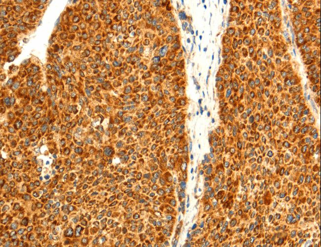 DIABLO / SMAC Antibody - Immunohistochemistry of paraffin-embedded Human liver cancer using DIABLO Polyclonal Antibody at dilution of 1:50.