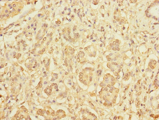 DIAPH2 Antibody - Immunohistochemistry of paraffin-embedded human pancreatic cancer at dilution 1:100