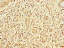 DIAPH2 Antibody - Immunohistochemistry of paraffin-embedded human pancreatic cancer at dilution 1:100