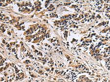 DIAPH2 Antibody - Immunohistochemistry of paraffin-embedded Human breast cancer tissue  using DIAPH2 Polyclonal Antibody at dilution of 1:55(×200)