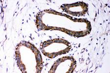 DICER1 / Dicer Antibody - Dicer antibody IHC-paraffin: Human Mammary Cancer Tissue.