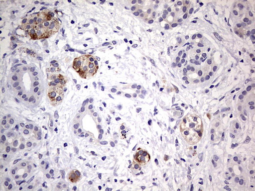 DICER1 / Dicer Antibody - IHC of paraffin-embedded Carcinoma of Human pancreas tissue using anti-DICER1 mouse monoclonal antibody. (Heat-induced epitope retrieval by 1 mM EDTA in 10mM Tris, pH8.5, 120°C for 3min).