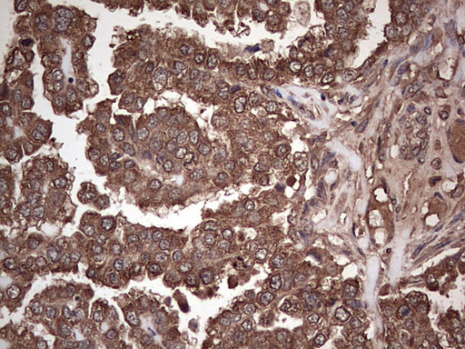 DICER1 / Dicer Antibody - IHC of paraffin-embedded Adenocarcinoma of Human ovary tissue using anti-DICER1 mouse monoclonal antibody. (Heat-induced epitope retrieval by 1 mM EDTA in 10mM Tris, pH8.5, 120°C for 3min).
