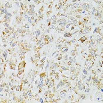 DICER1 / Dicer Antibody - Immunohistochemistry of paraffin-embedded human lung cancer tissue.