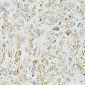 DICER1 / Dicer Antibody - Immunohistochemistry of paraffin-embedded human lung cancer tissue.