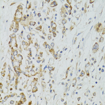 DICER1 / Dicer Antibody - Immunohistochemistry of paraffin-embedded human gastric cancer tissue.