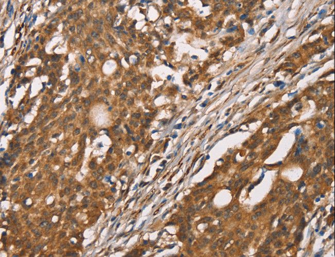 DICER1 / Dicer Antibody - Immunohistochemistry of paraffin-embedded Human thyroid cancer using DICER1 Polyclonal Antibody at dilution of 1:40.