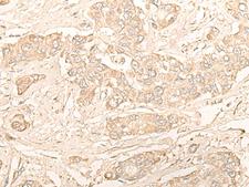 DIMT1L Antibody - Immunohistochemistry of paraffin-embedded Human liver cancer tissue  using DIMT1 Polyclonal Antibody at dilution of 1:30(×200)