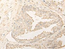 DIMT1L Antibody - Immunohistochemistry of paraffin-embedded Human prost at e cancer tissue  using DIMT1 Polyclonal Antibody at dilution of 1:35(×200)