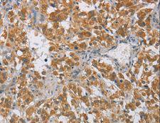 DIO1 / TXDI1 Antibody - Immunohistochemistry of paraffin-embedded Human cervical cancer using DIDO1 Polyclonal Antibody at dilution of 1:60.
