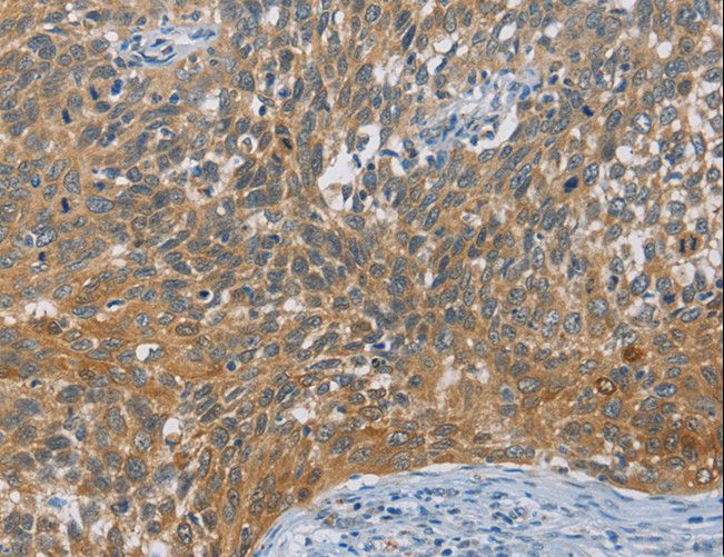 DIO1 / TXDI1 Antibody - Immunohistochemistry of paraffin-embedded Human cervical cancer using DIDO1 Polyclonal Antibody at dilution of 1:60.