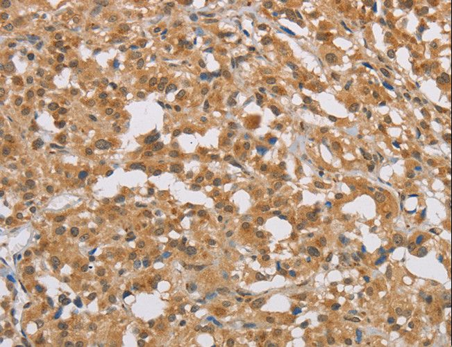 DIO1 / TXDI1 Antibody - Immunohistochemistry of paraffin-embedded Human cervical cancer using DIDO1 Polyclonal Antibody at dilution of 1:50.