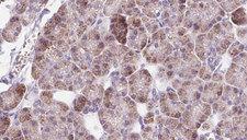 DIO1 / TXDI1 Antibody - 1:100 staining human pancreas carcinoma tissue by IHC-P. The sample was formaldehyde fixed and a heat mediated antigen retrieval step in citrate buffer was performed. The sample was then blocked and incubated with the antibody for 1.5 hours at 22°C. An HRP conjugated goat anti-rabbit antibody was used as the secondary.