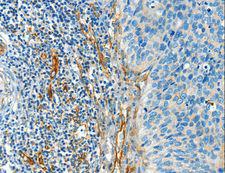 DIO2 Antibody - Immunohistochemistry of paraffin-embedded Human cervical cancer using DIO2 Polyclonal Antibody at dilution of 1:50.