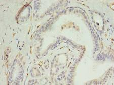 DIP2A Antibody - Immunohistochemistry of paraffin-embedded human breast cancer using antibody at dilution of 1:100.