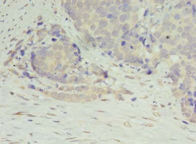 DIP2A Antibody - Immunohistochemistry of paraffin-embedded human gastric cancer using antibody at dilution of 1:100.