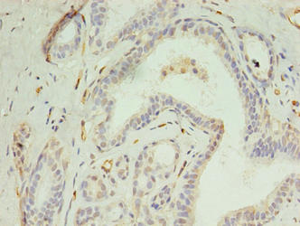 DIP2A Antibody - Immunohistochemistry of paraffin-embedded human breast cancer using DIP2A Antibody at dilution of 1:100