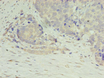 DIP2A Antibody - Immunohistochemistry of paraffin-embedded human gastric cancer using DIP2A Antibody at dilution of 1:100