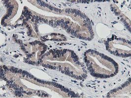 Dipeptidyl Peptidase 3 / DPP3 Antibody - IHC of paraffin-embedded Adenocarcinoma of Human colon tissue using anti-DPP3 mouse monoclonal antibody. (Heat-induced epitope retrieval by 10mM citric buffer, pH6.0, 100C for 10min).