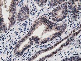 Dipeptidyl Peptidase 3 / DPP3 Antibody - IHC of paraffin-embedded Adenocarcinoma of Human endometrium tissue using anti-DPP3 mouse monoclonal antibody. (Heat-induced epitope retrieval by 10mM citric buffer, pH6.0, 100C for 10min).