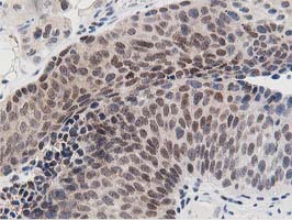 Dipeptidyl Peptidase 3 / DPP3 Antibody - IHC of paraffin-embedded Carcinoma of Human bladder tissue using anti-DPP3 mouse monoclonal antibody. (Heat-induced epitope retrieval by 10mM citric buffer, pH6.0, 100C for 10min).