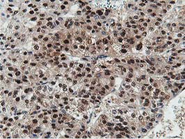 Dipeptidyl Peptidase 3 / DPP3 Antibody - IHC of paraffin-embedded Carcinoma of Human liver tissue using anti-DPP3 mouse monoclonal antibody. (Heat-induced epitope retrieval by 10mM citric buffer, pH6.0, 100C for 10min).
