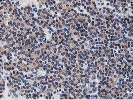 Dipeptidyl Peptidase 3 / DPP3 Antibody - IHC of paraffin-embedded Carcinoma of Human thyroid tissue using anti-DPP3 mouse monoclonal antibody. (Heat-induced epitope retrieval by 10mM citric buffer, pH6.0, 100C for 10min).