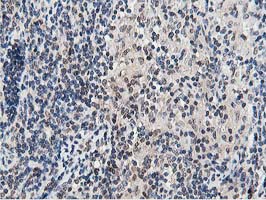 Dipeptidyl Peptidase 3 / DPP3 Antibody - IHC of paraffin-embedded Human lymphoma tissue using anti-DPP3 mouse monoclonal antibody. (Heat-induced epitope retrieval by 10mM citric buffer, pH6.0, 100C for 10min).