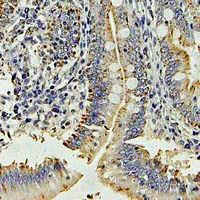 Dipeptidyl Peptidase 3 / DPP3 Antibody - Immunohistochemical analysis of DPP3 staining in human colon cancer formalin fixed paraffin embedded tissue section. The section was pre-treated using heat mediated antigen retrieval with sodium citrate buffer (pH 6.0). The section was then incubated with the antibody at room temperature and detected using an HRP conjugated compact polymer system. DAB was used as the chromogen. The section was then counterstained with hematoxylin and mounted with DPX.