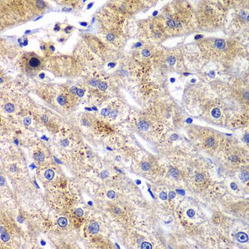 Dipeptidyl Peptidase 3 / DPP3 Antibody - Immunohistochemistry of paraffin-embedded human liver injury using DPP3 antibody at dilution of 1:100 (40x lens).