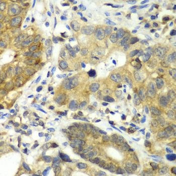 Dipeptidyl Peptidase 3 / DPP3 Antibody - Immunohistochemistry of paraffin-embedded human gastric cancer using DPP3 antibody at dilution of 1:100 (40x lens).