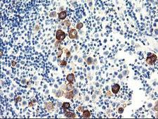 Dipeptidylpeptidase 10 / DPP10 Antibody - IHC of paraffin-embedded Carcinoma of Human lung tissue using anti-DPP10 mouse monoclonal antibody.