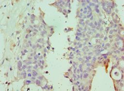Dipeptidylpeptidase 8 / DPP8 Antibody - Immunohistochemistry of paraffin-embedded human endometrial cancer using antibody at 1:100 dilution.