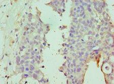 Dipeptidylpeptidase 8 / DPP8 Antibody - Immunohistochemistry of paraffin-embedded human endometrial cancer using antibody at 1:100 dilution.