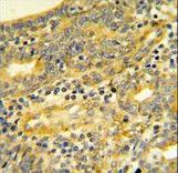 Dipeptidylpeptidase 8 / DPP8 Antibody - DPP8 Antibody IHC of formalin-fixed and paraffin-embedded human Prostate carcinoma followed by peroxidase-conjugated secondary antibody and DAB staining.