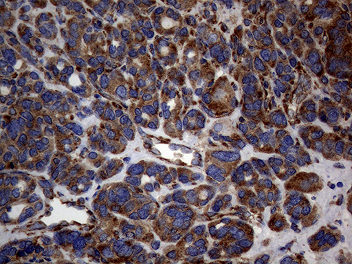 DIRAS2 Antibody - Immunohistochemical staining of paraffin-embedded Carcinoma of Human thyroid tissue using anti-DIRAS2 mouse monoclonal antibody. (Heat-induced epitope retrieval by 1mM EDTA in 10mM Tris buffer. (pH8.5) at 120°C for 3 min. (1:150)