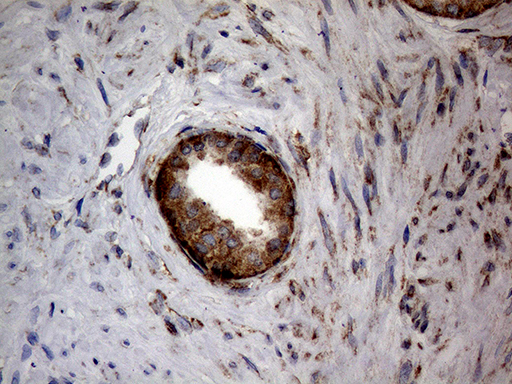 DIRAS2 Antibody - Immunohistochemical staining of paraffin-embedded Carcinoma of Human prostate tissue using anti-DIRAS2 mouse monoclonal antibody. (Heat-induced epitope retrieval by 1mM EDTA in 10mM Tris buffer. (pH8.5) at 120°C for 3 min. (1:150)