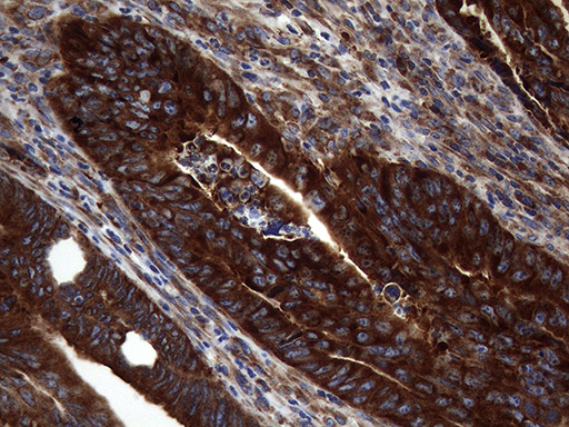DIRAS2 Antibody - Immunohistochemical staining of paraffin-embedded Adenocarcinoma of Human colon tissue using anti-DIRAS2 mouse monoclonal antibody. (Heat-induced epitope retrieval by 1mM EDTA in 10mM Tris buffer. (pH8.5) at 120°C for 3 min. (1:150)
