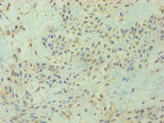 DIRAS3 / ARHI Antibody - Immunohistochemistry of paraffin-embedded human breast cancer using antibody at 1:100 dilution.