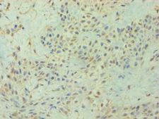 DIRAS3 / ARHI Antibody - Immunohistochemistry of paraffin-embedded human breast cancer using antibody at 1:100 dilution.