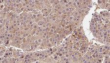 DIRAS3 / ARHI Antibody - 1:100 staining human liver carcinoma tissues by IHC-P. The sample was formaldehyde fixed and a heat mediated antigen retrieval step in citrate buffer was performed. The sample was then blocked and incubated with the antibody for 1.5 hours at 22°C. An HRP conjugated goat anti-rabbit antibody was used as the secondary.