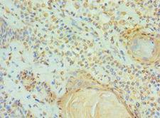 DIS / CCAR1 Antibody - Immunohistochemistry of paraffin-embedded human breast cancer using antibody at 1:100 dilution.