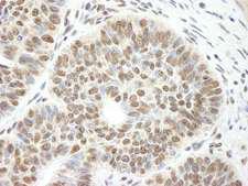 DIS / CCAR1 Antibody - Detection of Human CCAR1 by Immunohistochemistry. Sample: FFPE section of human skin basal cell carcinoma. Antibody: Affinity purified rabbit anti-CCAR1 used at a dilution of 1:250. Detection: DAB staining using anti-Rabbit IHC antibody at a dilution of 1:100.