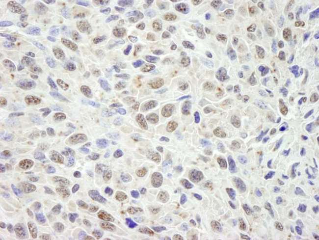 DIS / CCAR1 Antibody - Detection of Mouse CCAR1 by Immunohistochemistry. Sample: FFPE section of mouse squamous cell carcinoma. Antibody: Affinity purified rabbit anti-CCAR1 used at a dilution of 1:250. Detection: DAB staining using anti-Rabbit IHC antibody at a dilution of 1:100.