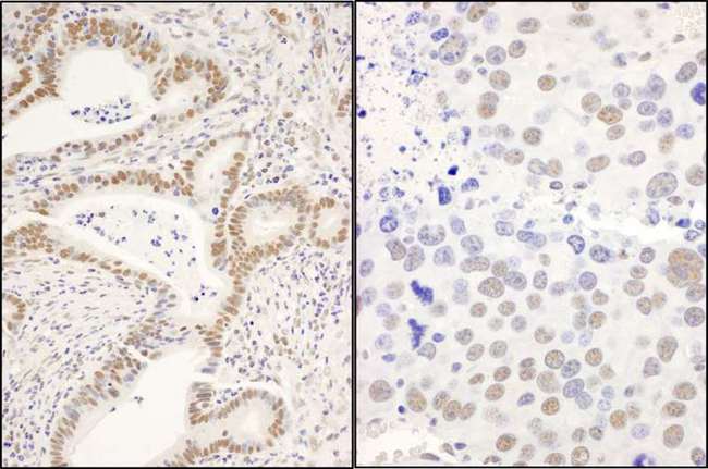 DIS / CCAR1 Antibody - Detection of Human and Mouse CCAR1 by Immunohistochemistry. Sample: FFPE section of human stomach carcinoma (left) and mouse renal cell carcinoma (right). Antibody: Affinity purified rabbit anti-CCAR1 used at a dilution of 1:1000 (1 ug/ml). Detection: DAB.