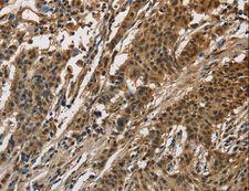 DIS / CCAR1 Antibody - Immunohistochemistry of paraffin-embedded Human liver cancer using CCAR1 Polyclonal Antibody at dilution of 1:40.
