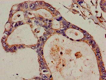 DIS3 Antibody - Immunohistochemistry image of paraffin-embedded human pancreatic cancer at a dilution of 1:100