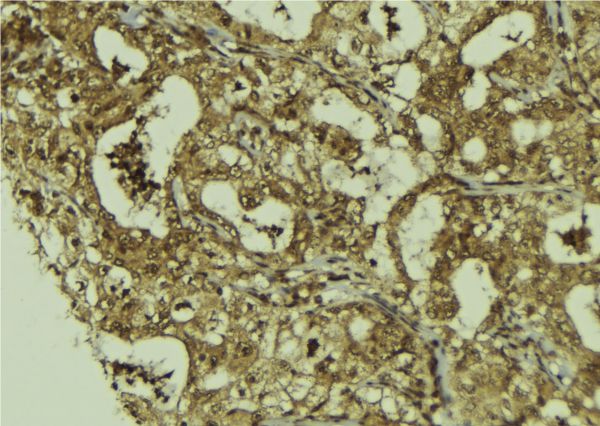 DIS3 Antibody - 1:100 staining human breast carcinoma tissue by IHC-P. The sample was formaldehyde fixed and a heat mediated antigen retrieval step in citrate buffer was performed. The sample was then blocked and incubated with the antibody for 1.5 hours at 22°C. An HRP conjugated goat anti-rabbit antibody was used as the secondary.