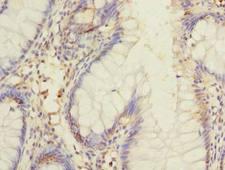 DIS3L Antibody - Immunohistochemistry of paraffin-embedded human colon cancer using antibody at dilution of 1:100.